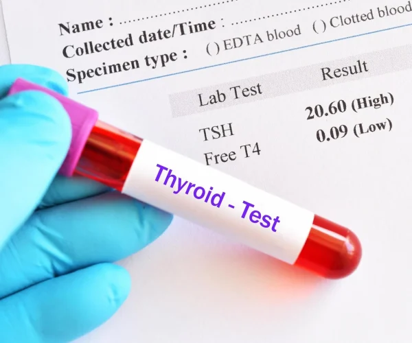 hypothyroidism result with blood sample tube